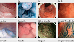 Франкфуртская классификация ВЗК-ассоциированных новообразований (FACILE)